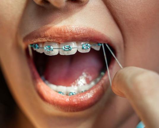 Teen shows the elastics on her braces