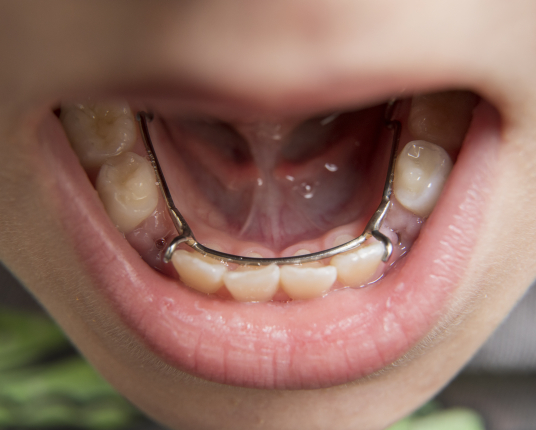 Closeup of smile with space maintainers after tooth extractions