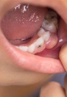 Closeup of a boy’s mouth with cavities