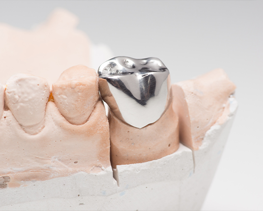 Model smile with stainless steel dental crown