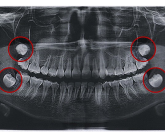 dental X-ray with the wisdom teeth highlighted 