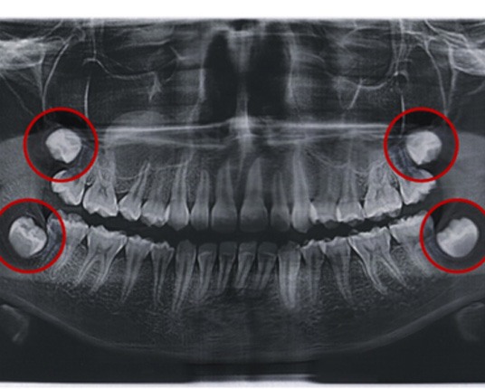 dental X-ray with the wisdom teeth highlighted