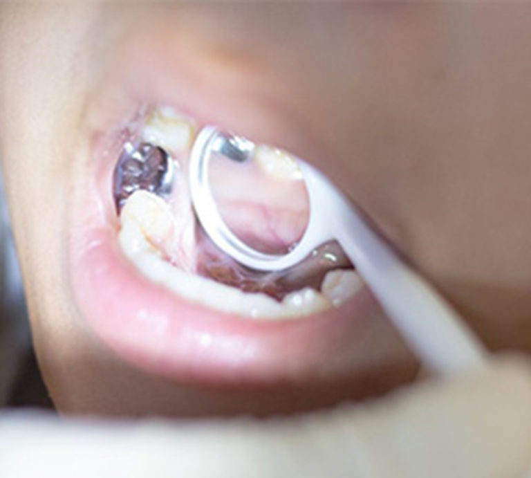 Stainless Steel Dental Crowns for Kids What You Need to Know Coral