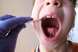 Frenum of young patient shown with mouth open.
